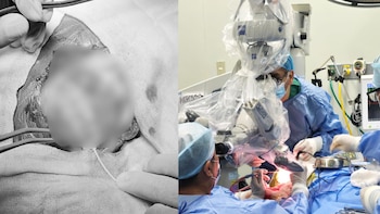 Un equipo multidisciplinario del Instituto Nacional de Salud del Niño (INSN) logró controlar por completo las crisis epilépticas de Jhino, un niño de solo un año y un mes, mediante una cirugía cerebral altamente especializada - Créditos: INSN.