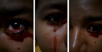 Barranquillera padece extraña condición que