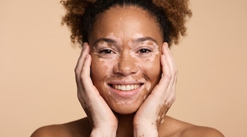 Retrato en primer plano de una mujer multiétnica sonriendo con manchas de vitíligo en su rostro y manos, sobre un fondo beige.