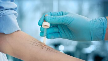 Mediante un test de alergia