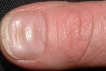 Esta alteración indica resistencia a