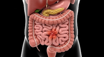 Ilustración médica 3D que muestra el sistema digestivo humano con los intestinos en el centro, destacando una sección del intestino delgado con inflamación rojiza.