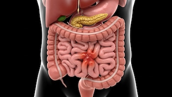 Síndrome de Intestino irritable: por qué ahora más pacientes pueden recibir diagnóstico