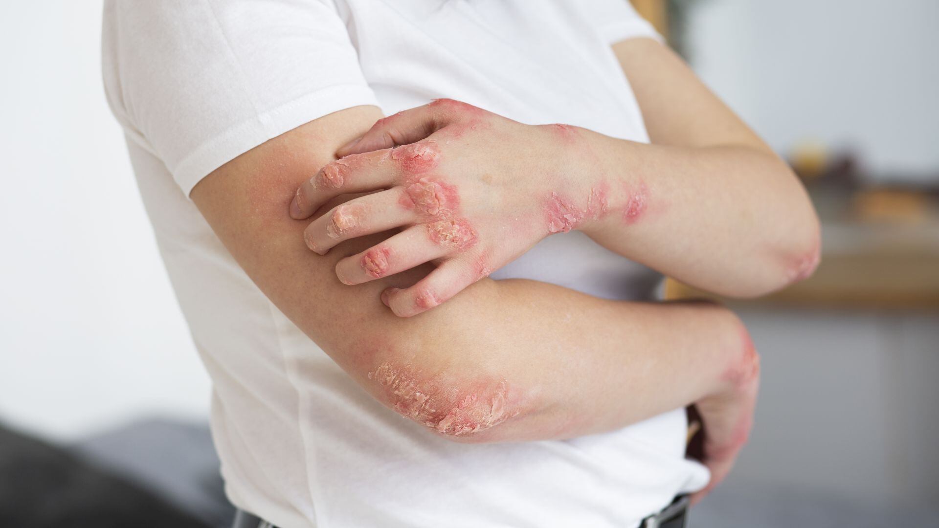 Esta enfermedad crónica se distingue por placas rojas y escamas plateadas que aparecen en distintas zonas del cuerpo y pueden afectar tanto la salud física como la emocional (Freepik)