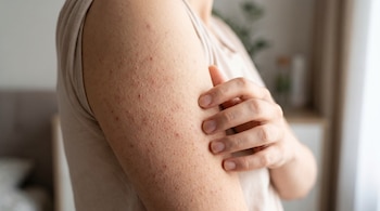 Primer plano del brazo de una persona con queratosis pilaris, mostrando pequeñas protuberancias rojas y textura áspera; una mano toca el área.