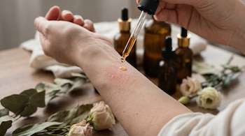 Primer plano de una mano aplicando una gota de aceite esencial con un gotero sobre un antebrazo que presenta enrojecimiento y ronchas, con frascos borrosos al fondo.