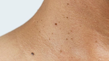 ¿Por qué aparecen los lunares de carne? Señales para acudir al dermatólogo