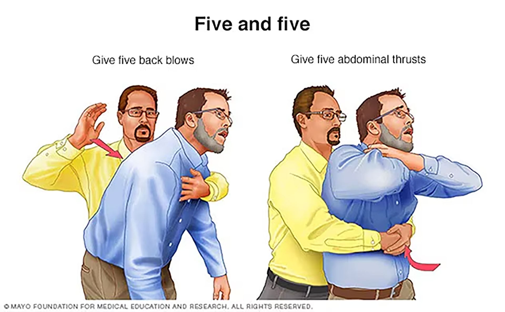 La asistencia ante un atragantamiento alterna cinco golpes firmes en la espalda con cinco compresiones en el abdomen (Mayo Clinic)