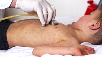 Si bien la enfermedad no