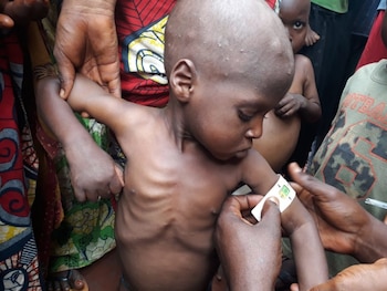 21/09/2019 Un niño con desnutricíon