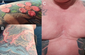 Cambios en la piel dentro