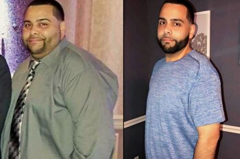 ¿Qué es la Manga Gástrica?