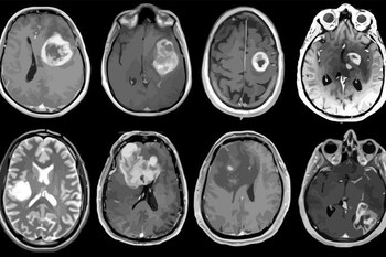 Tumor cerebral agresivo mapeado en