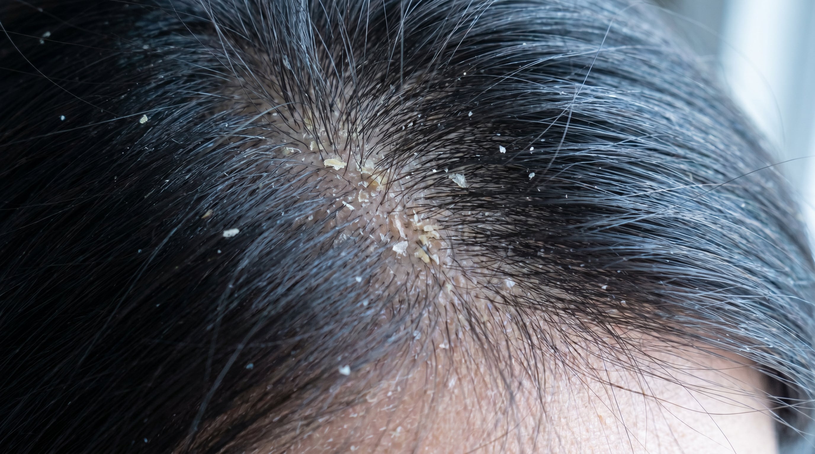 Teñir el cabello mensualmente puede generar sequedad, descamación, sensación de tirantez y aumentar la vulnerabilidad del cuero cabelludo frente a irritaciones e infecciones. (Imagen Ilustrativa Infobae)