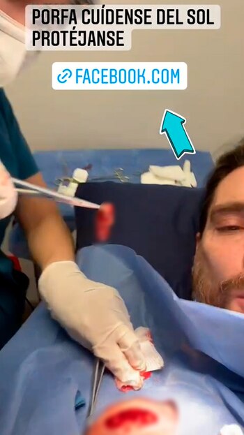 Julián Gil, Cáncer de piel
