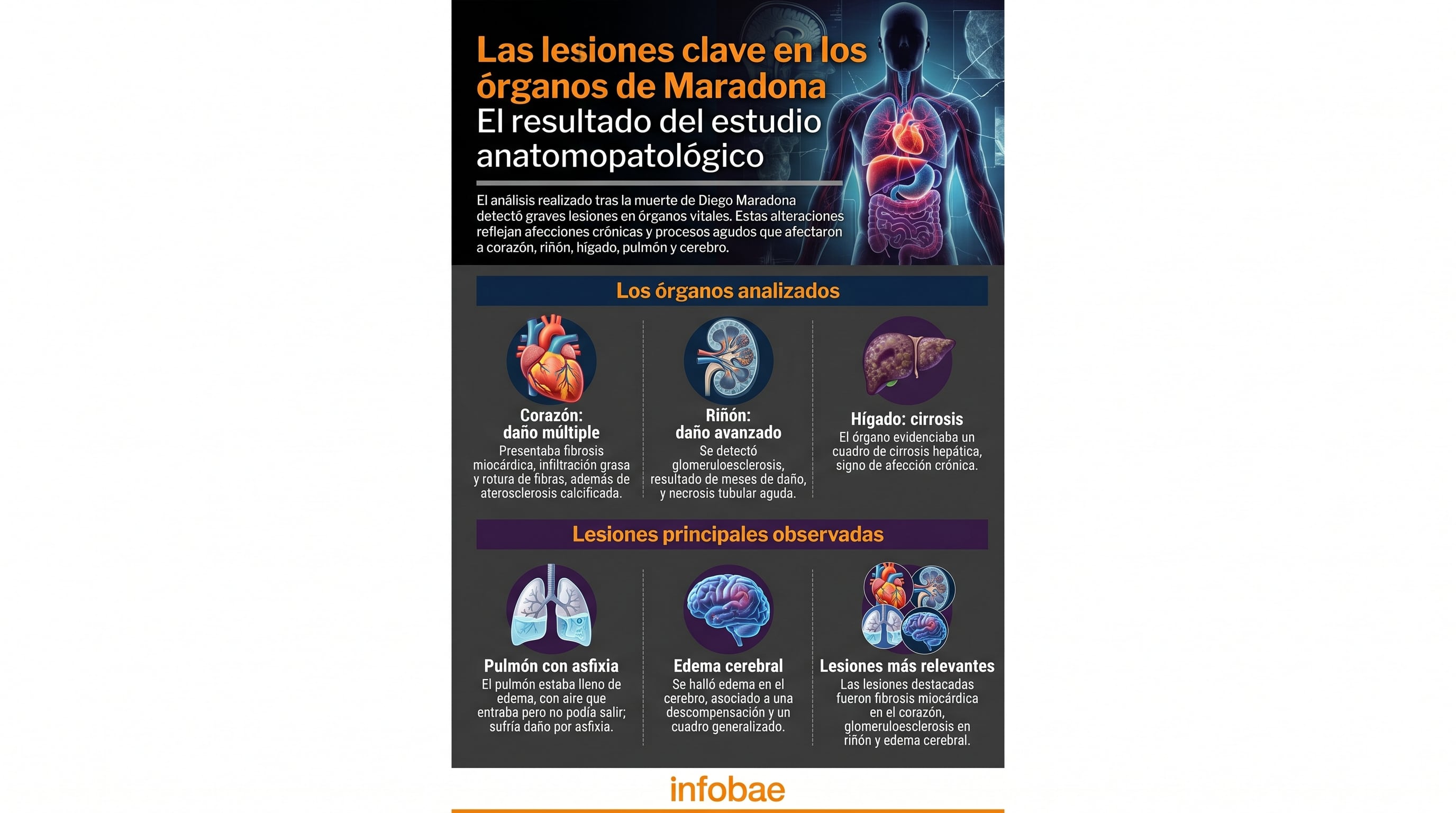 Las graves lesiones detectadas en el corazón, riñón, hígado, pulmones y cerebro de Diego Maradona, según el estudio anatomopatológico presentado en el juicio por su muerte (Imagen Ilustrativa Infobae)