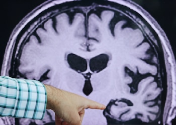 Para el diagnóstico se solicitan como la tomografía computarizada (TC) o la resonancia magnética nuclear (RMN) para detectar anomalías del encéfalo.REUTERS/Brian Snyder