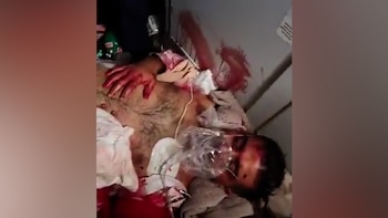 Una persona recostada con manchas rojas en el pecho, las manos y la cara, y una máscara transparente sobre la rostro