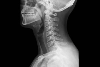 Placa de rayos X lateral del cuello de una persona sobre un fondo oscuro, mostrando las vértebras cervicales, la mandíbula y parte del cráneo.