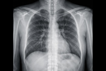 Radiografía frontal del pecho de una persona, revelando la estructura ósea del tórax, los pulmones y el área del corazón en tonos de gris sobre fondo negro.