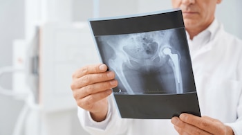 Primer plano de las manos de un médico sosteniendo una radiografía de la pelvis que muestra una prótesis de cadera.