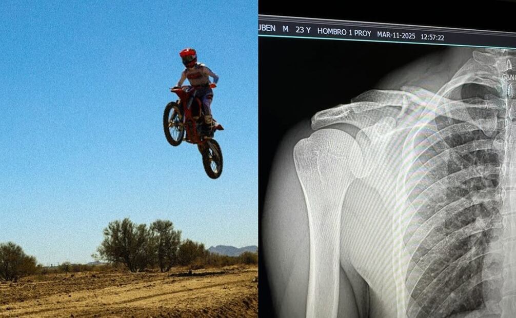 La superestrella de los corridos tumbados requirió cinco clavos de titanio en el hueso dañado | Fotos: Instagram / @natanael_cano