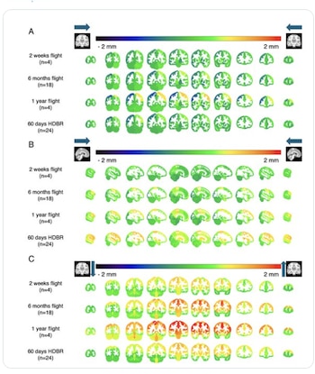 Estudios con resonancia magnética muestran