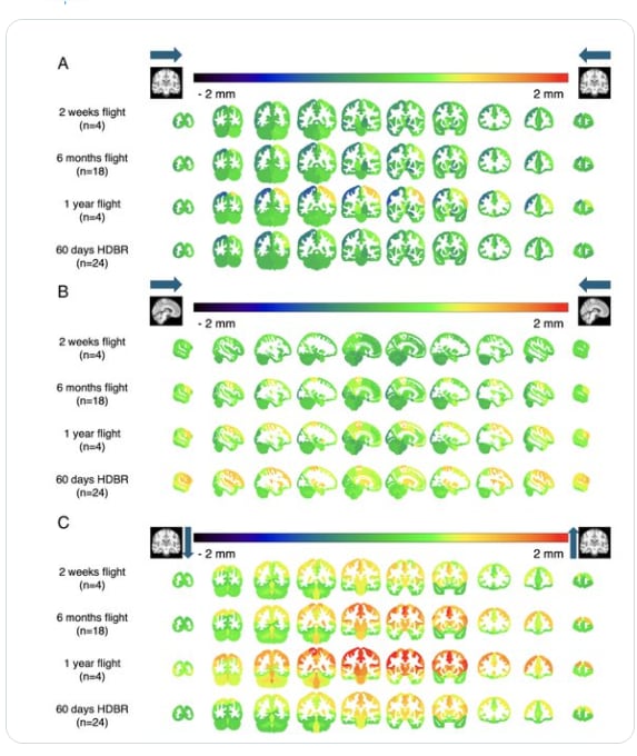 Estudios con resonancia magnética muestran que tras vuelos espaciales el cerebro se desplaza hacia arriba y atrás dentro del cráneo con cambios que pueden persistir meses (PNAS)