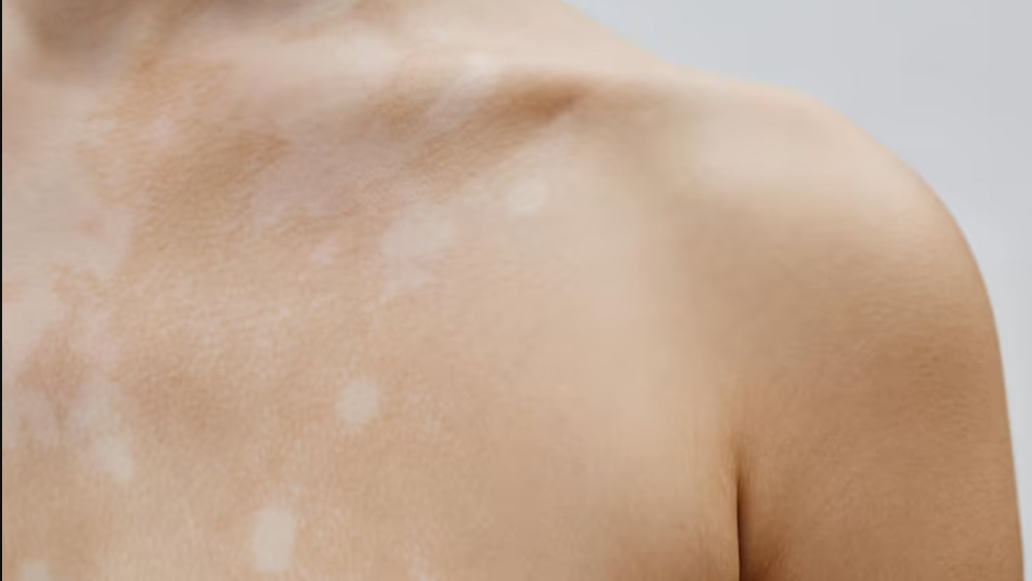 Las manchas blancas en la piel pueden indicar desde condiciones benignas hasta enfermedades que requieren atención dermatológica especializada (Freepik)