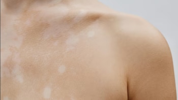 Las manchas blancas en la