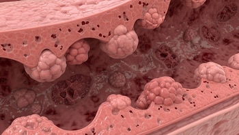 Cáncer colorrectal en jóvenes: vinculan la dieta, el tabaco y los pesticidas con el aumento de casos