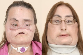 Imágenes de las distintas etapas