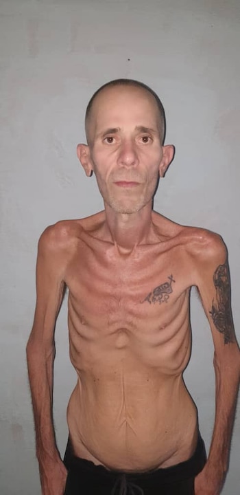 Alexander Díaz Rodríguez, un hombre demacrado con el torso desnudo, costillas y clavículas muy marcadas, pelo rapado, barba incipiente, y tatuajes en el brazo y pecho