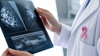 “Pasamos de tratamientos generales a específicos”: cómo la detección temprana y las nuevas cirugías cambian el abordaje del cáncer de mama