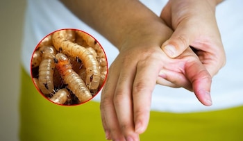 La miasis provocada por el gusano barrenador puede causar dolor, irritación y daño en los tejidos, por lo que Salud insiste en buscar atención médica ante cualquier cambio inusual en una herida. (FOTO: La Stampa)
