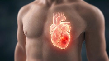 Qué es el infarto agudo de miocardio, la afección por la que fue operado Fernando Gago