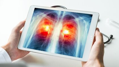 Cáncer de pulmón: cómo funciona la nueva inmunoterapia aprobada por la Anmat que busca prevenir las recaídas