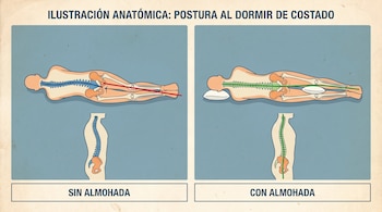 Ilustración anatómica comparando la postura de una persona que duerme de costado, mostrando la columna, pelvis y piernas con y sin almohada.