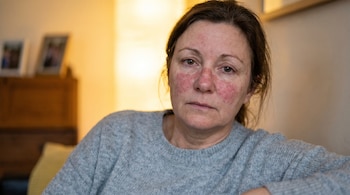 Primer plano frontal de una mujer de mediana edad con cabello castaño, mostrando enrojecimiento y erupciones en mejillas y nariz, con un suéter gris.