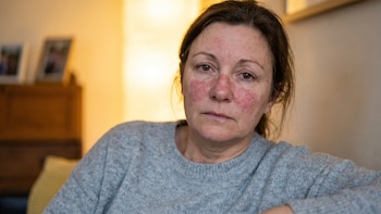 Lupus: cuáles son los primeros síntomas de la enfermedad que afecta a más de veinte mil mujeres en México