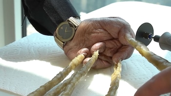 Las uñas de Melvin comenzaron