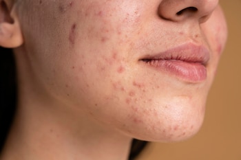 Una mujer con acné en la cara (Magnific)
