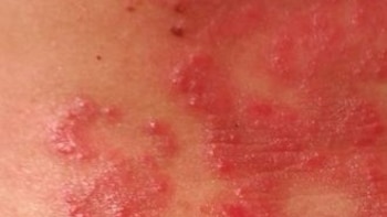 El primer caso de estos