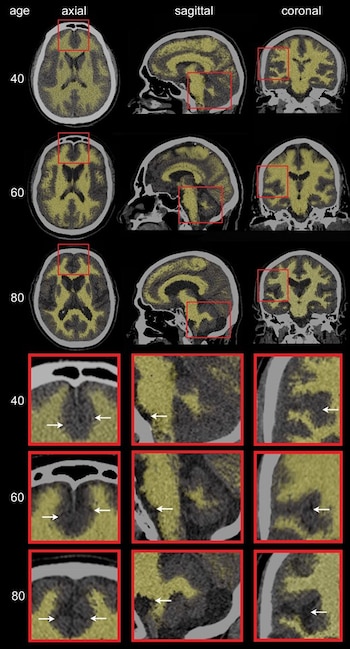 Tomografías cerebrales en planos axial, sagital y coronal para edades de 40, 60 y 80 años, con recuadros rojos y detalles señalados