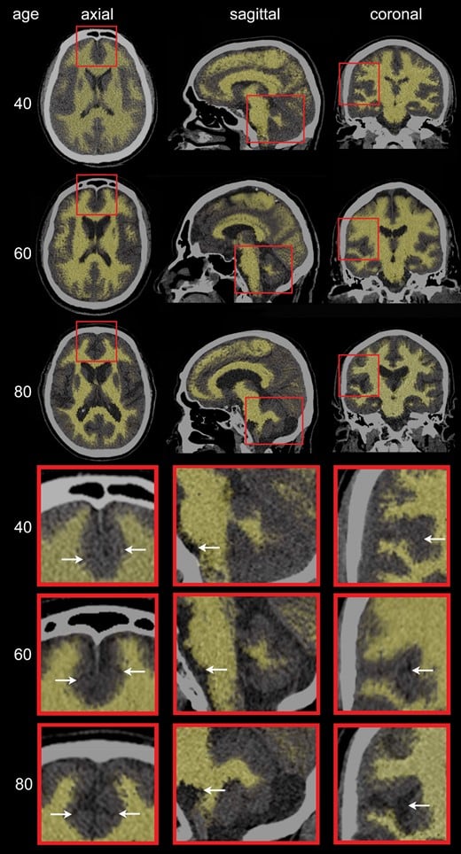 Un conjunto de tomografías computarizadas cerebrales ilustra los cambios estructurales según la edad en planos axial, sagital y coronal. (Revista Journals of Gerontology)