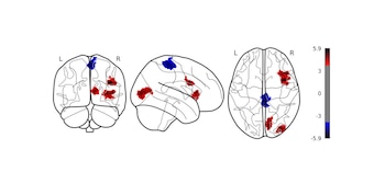 las zonas cerebrales donde el