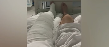 Vista desde la perspectiva de un paciente acostado en una cama de hospital con una pierna totalmente vendada y la otra descubierta