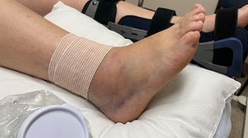 Primer plano de un tobillo vendado con hinchazón y hematomas. Se ve una compresa de hielo, una almohada y una bota ortopédica en segundo plano.