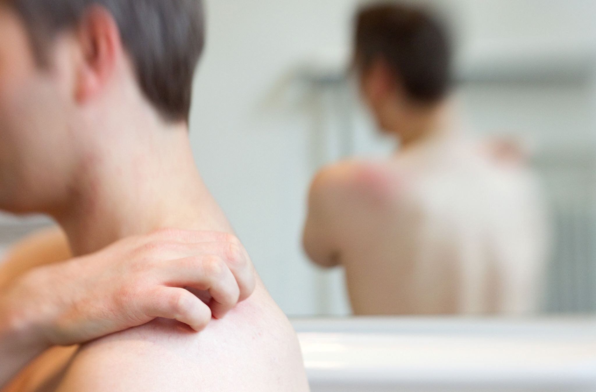 El herpes zóster puede derivar en complicaciones serias si no es tratado de manera oportuna - crédito Friso Gentsch/dpa