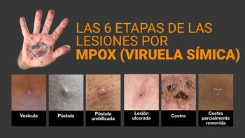 mpox
